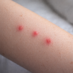 bed bug bites